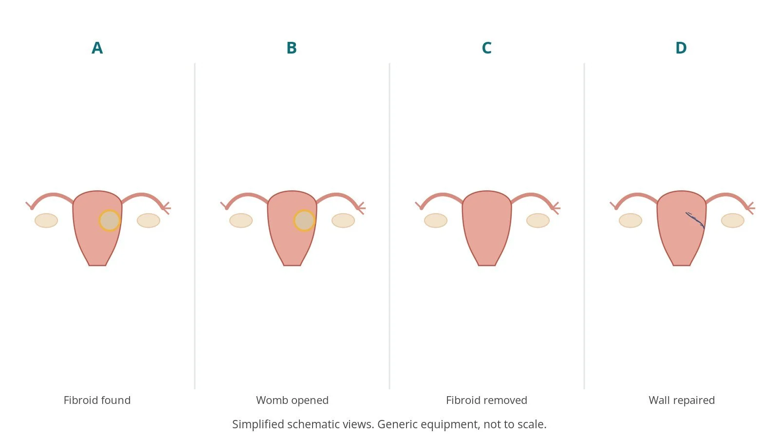 Four-panel schematic of myomectomy: fibroid found, womb opened, fibroid removed, wall repaired