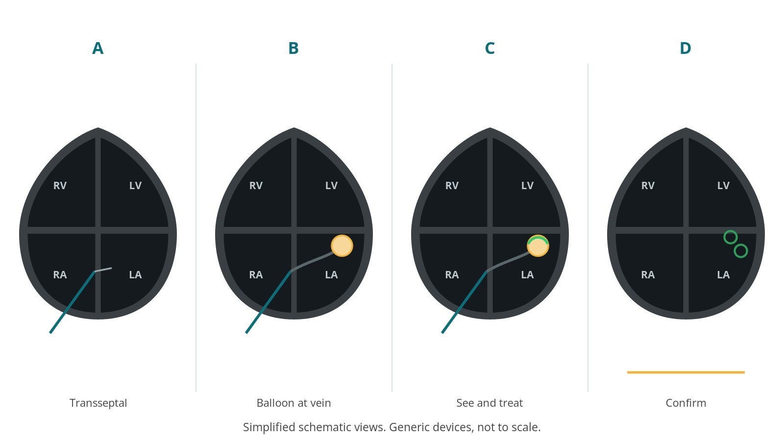 Four-panel schematic of laser ablation: transseptal, balloon at vein, see and treat, confirm