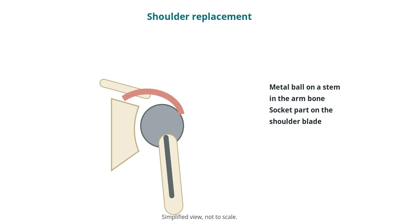 Diagram of the shoulder with a metal ball on a stem in the top of the arm bone