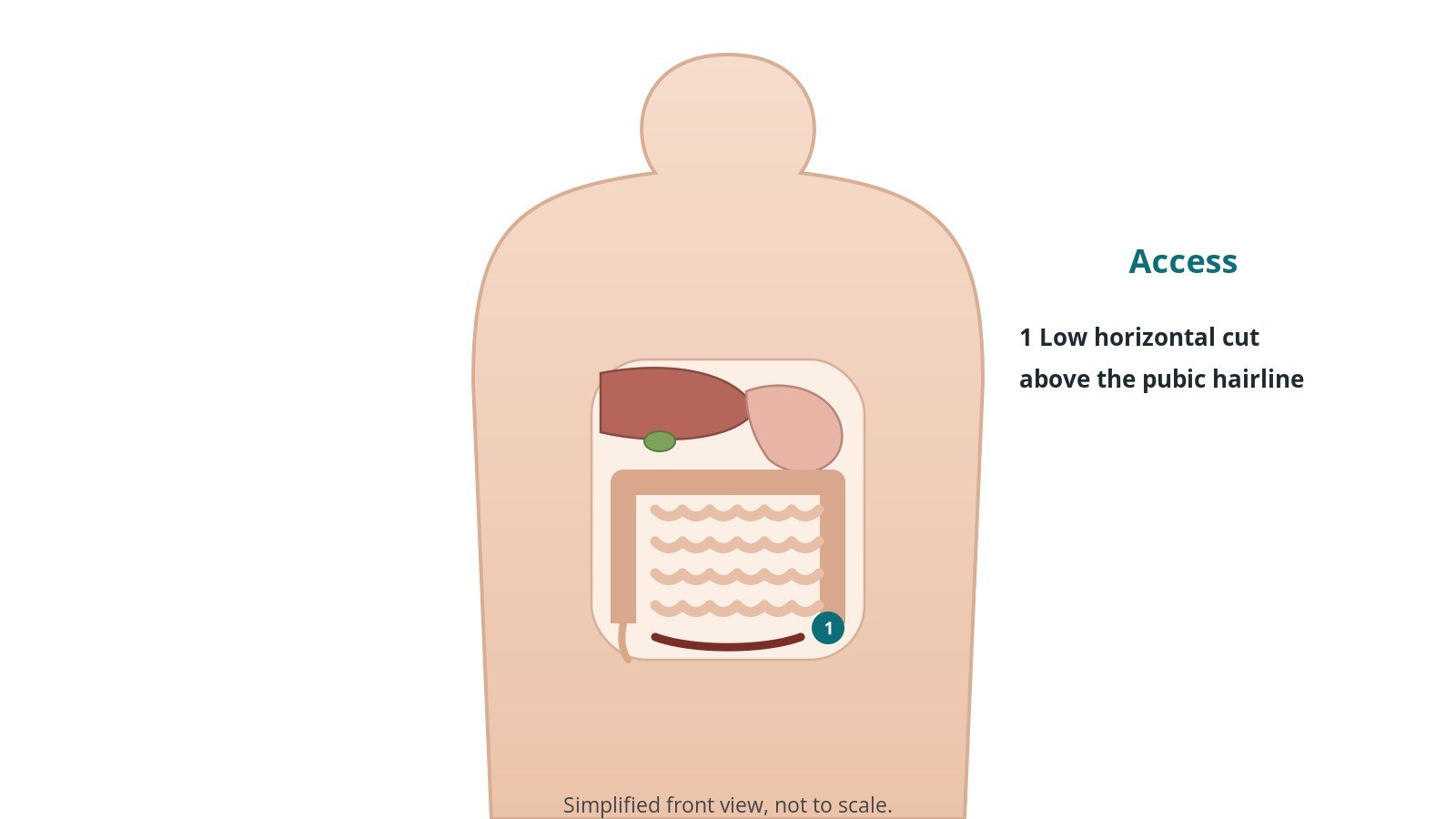 Front view of the abdomen showing a low horizontal incision just above the pubic hairline