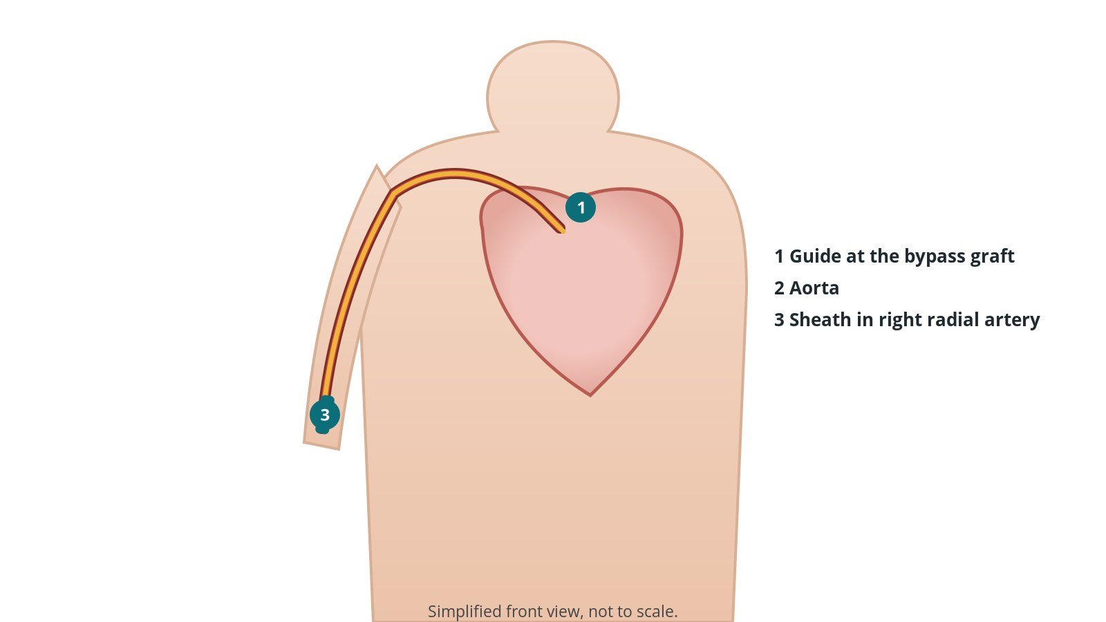 Front view of a patient showing a catheter from the right radial artery at the wrist up the arm into the aorta