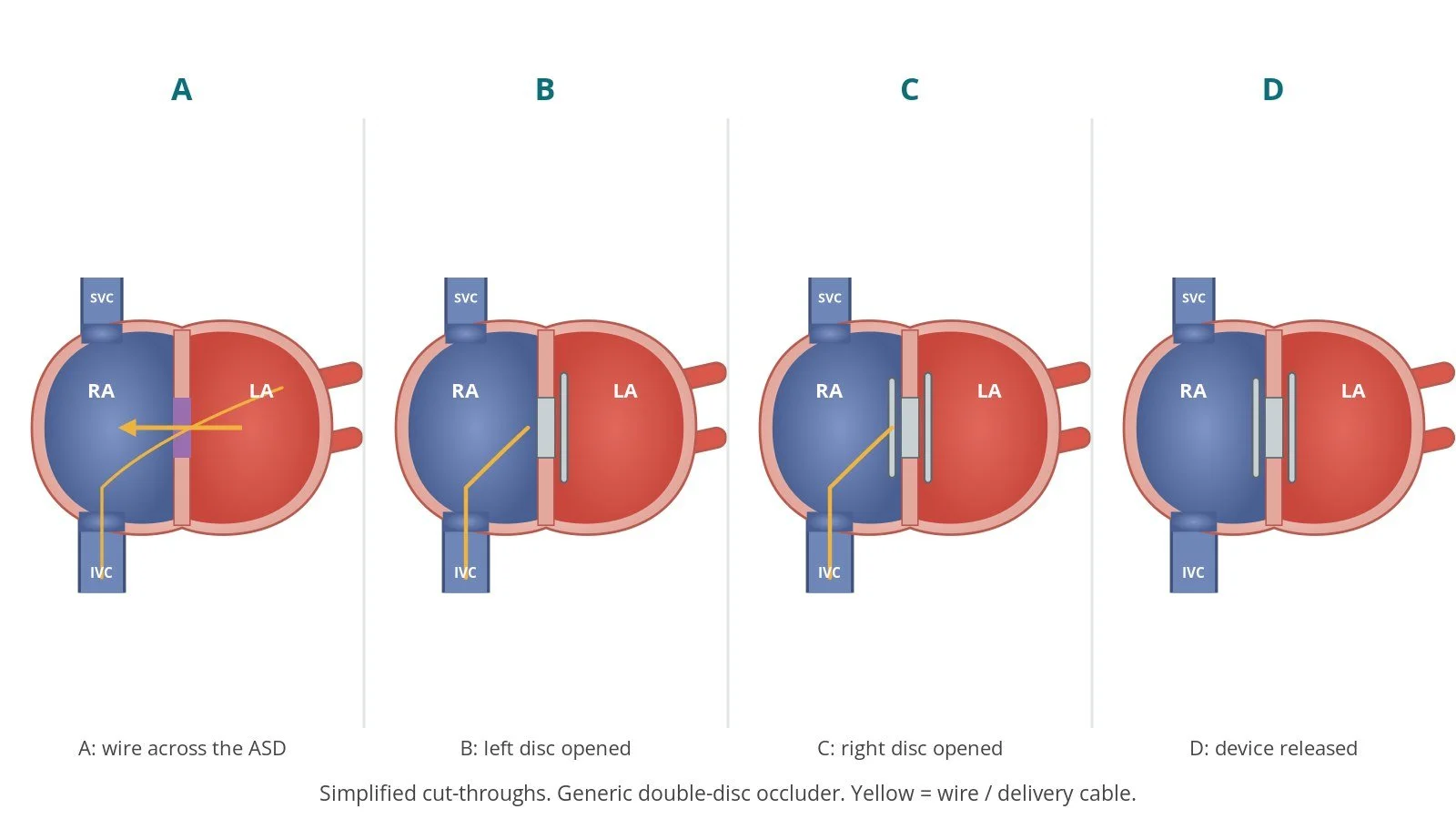 Four-panel diagram of ASD closure with a generic double-disc occluder: wire across the defect, left disc opened, right disc opened, device released