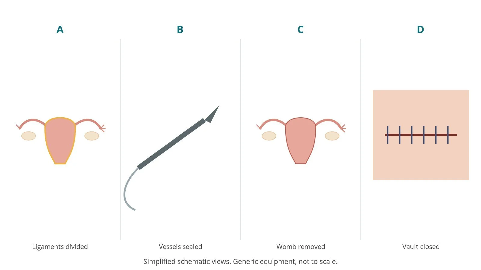 Four-panel schematic of hysterectomy: ligaments divided, vessels sealed, womb removed, vault closed