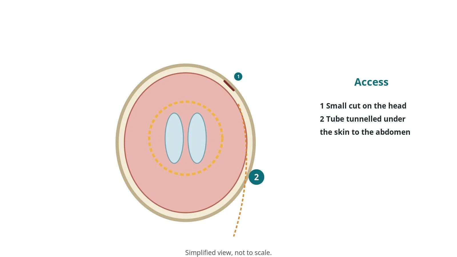 Diagram of the head with enlarged fluid spaces, a small head incision and the route of the tube downwards