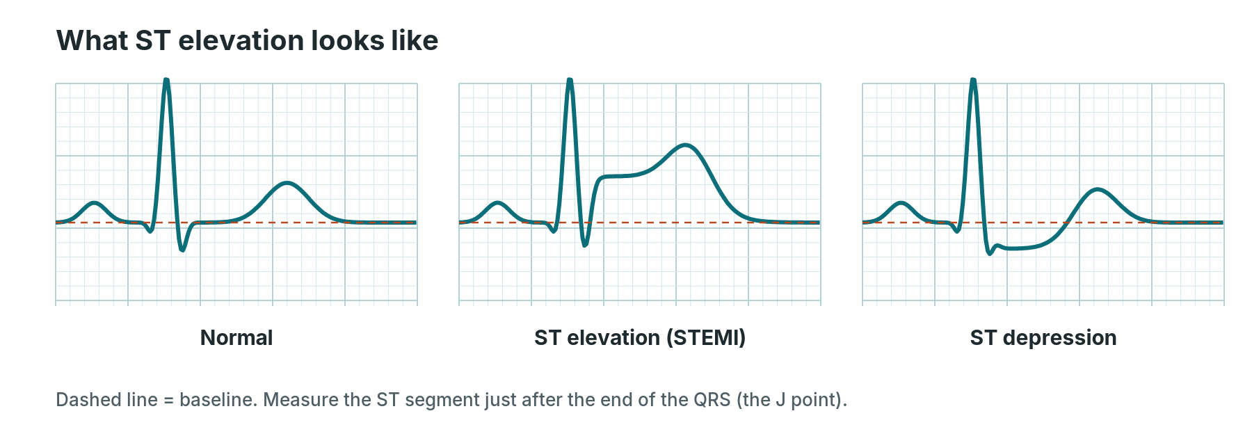 Comparison of a normal ST segment, ST elevation and ST depression