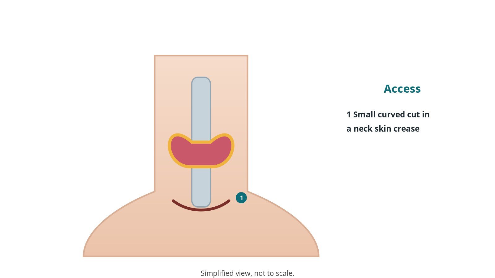 Front view of the neck showing a small curved incision in a skin crease over the thyroid gland