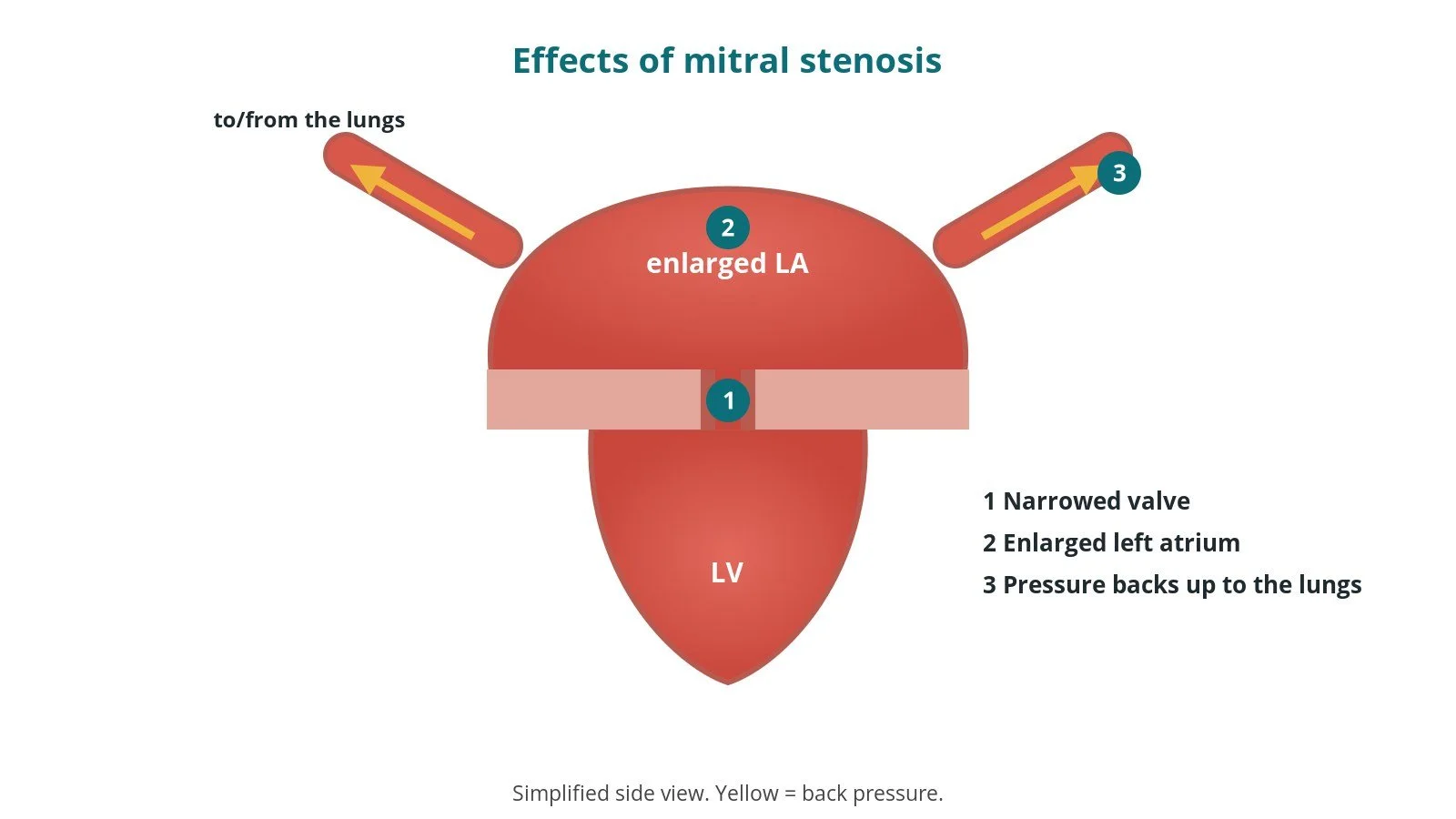 Diagram showing an enlarged left atrium behind a narrowed mitral valve, with back pressure into the lungs