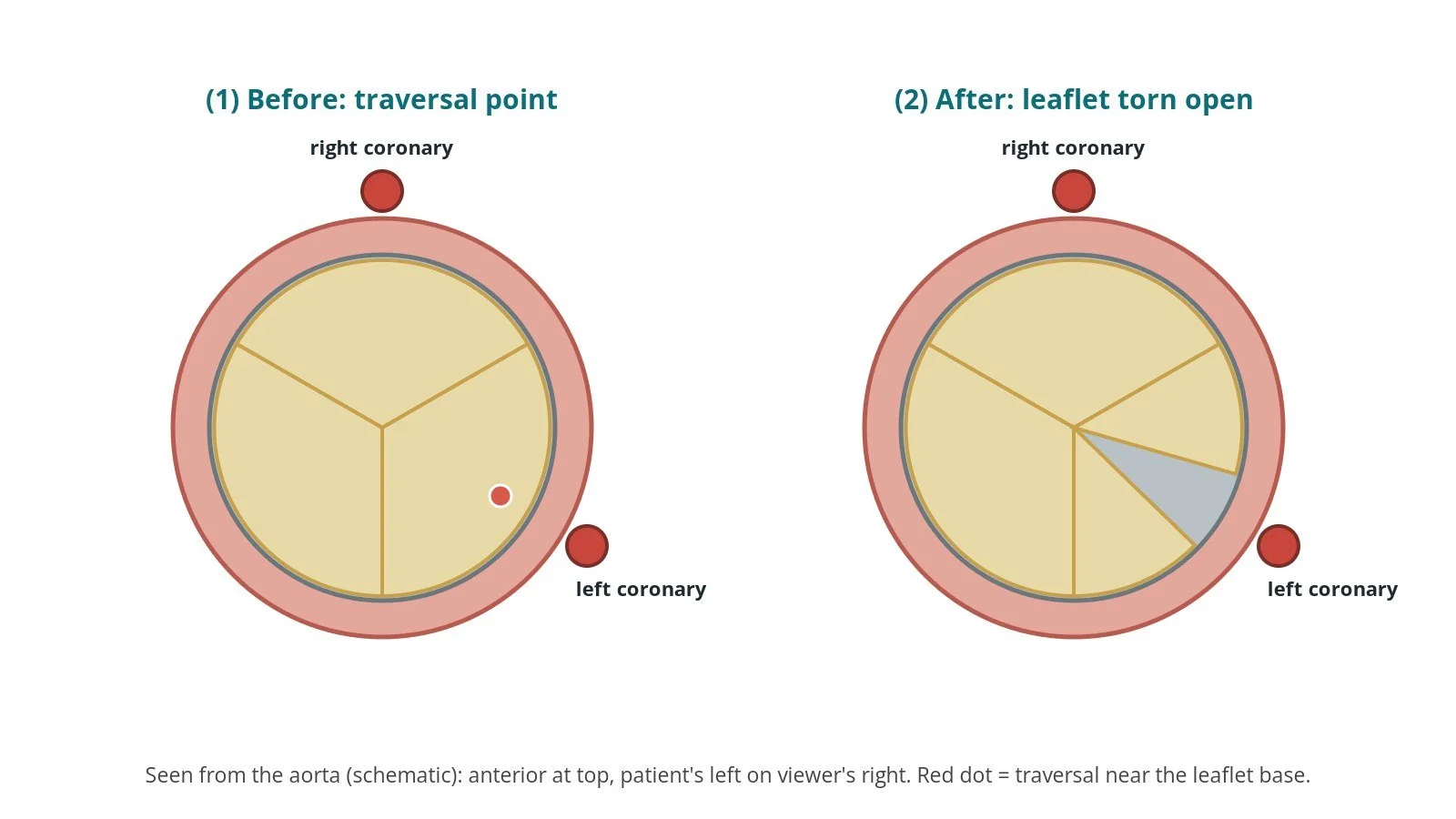 View of the aortic valve from above before and after LLAMACORN: three intact leaflets with coronary openings behind two of them, then the leaflet in front of the left coronary torn open at its middle