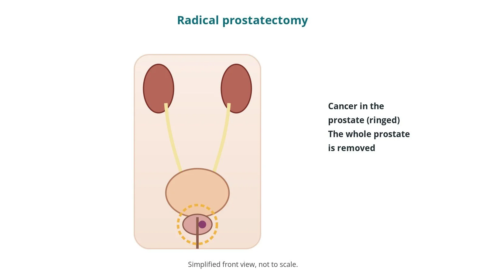 Diagram of the urinary tract with a small tumour in the prostate below the bladder, ringed
