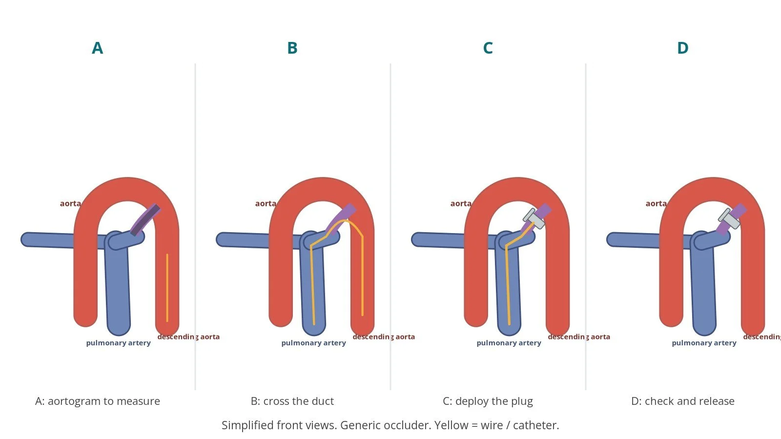 Four-panel diagram of PDA closure: aortogram of the duct, a catheter crossing it, a plug deployed in the duct, and the device released