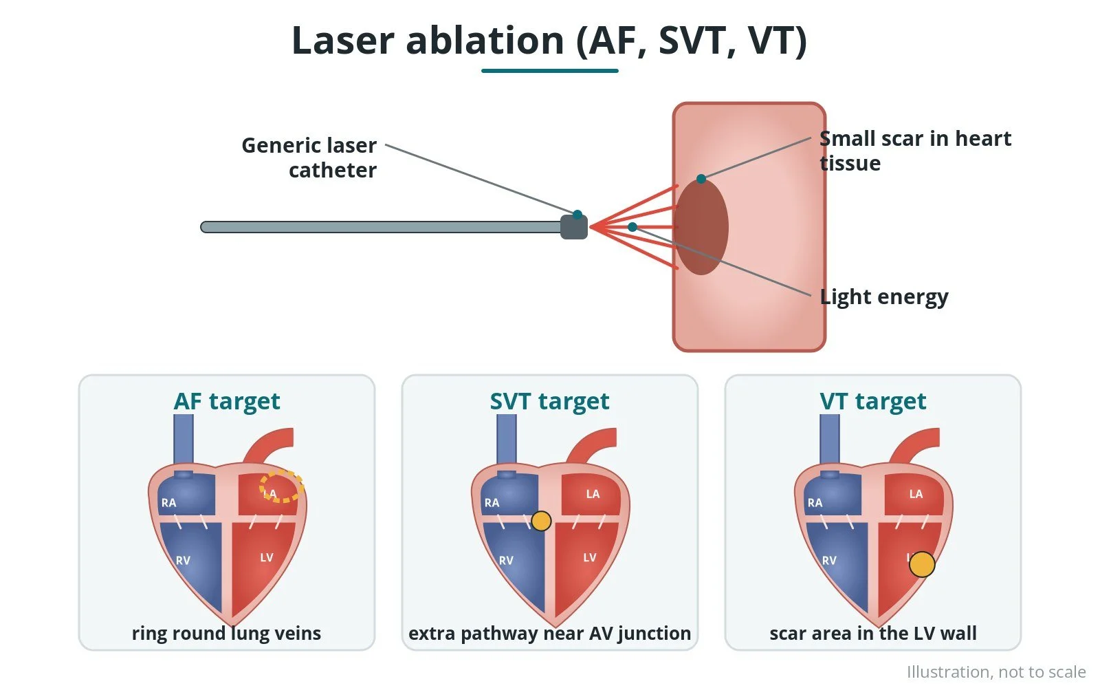 Diagram of a balloon catheter at a pulmonary vein delivering laser energy in a ring