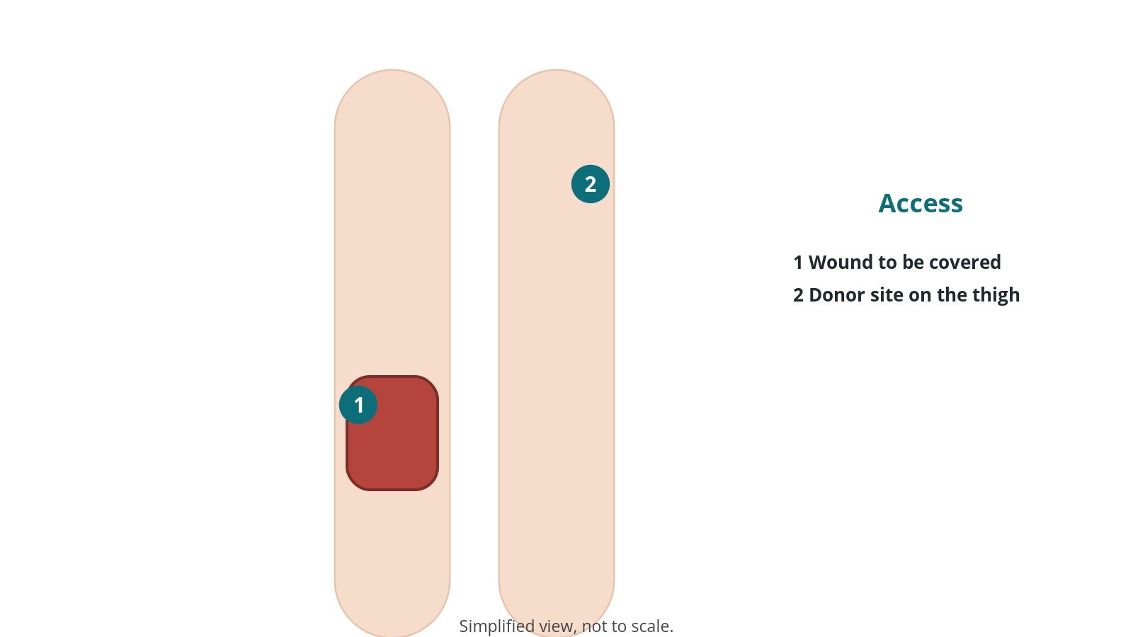 Diagram of two legs with a wound on one and a donor site on the other thigh