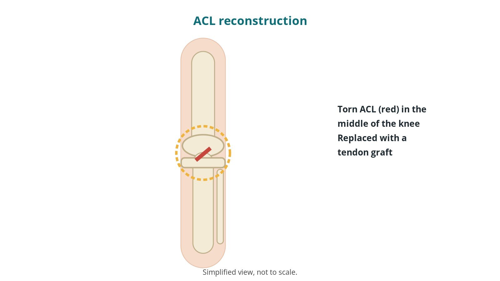 Diagram of a knee with the anterior cruciate ligament shown crossing the middle of the joint, ringed