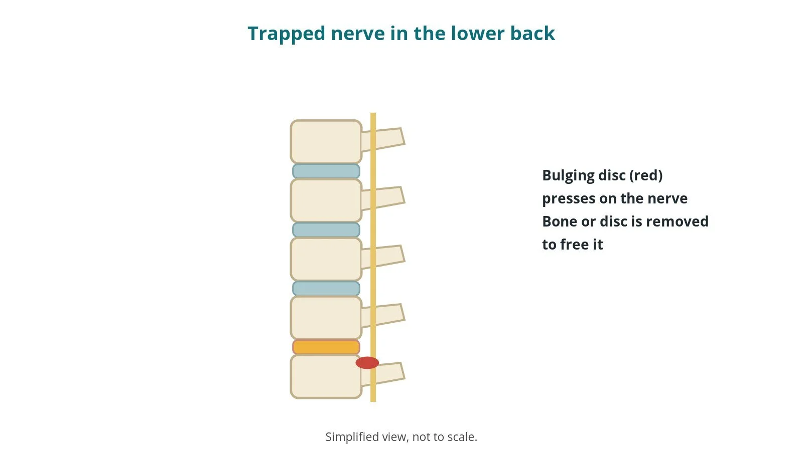 Side diagram of the lower spine with a disc bulging backwards and pressing on the nerve