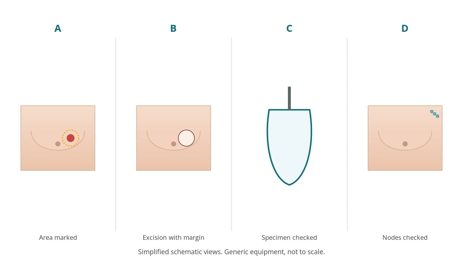 Four-panel schematic of wide local excision: area marked, excision with margin, specimen checked, nodes checked