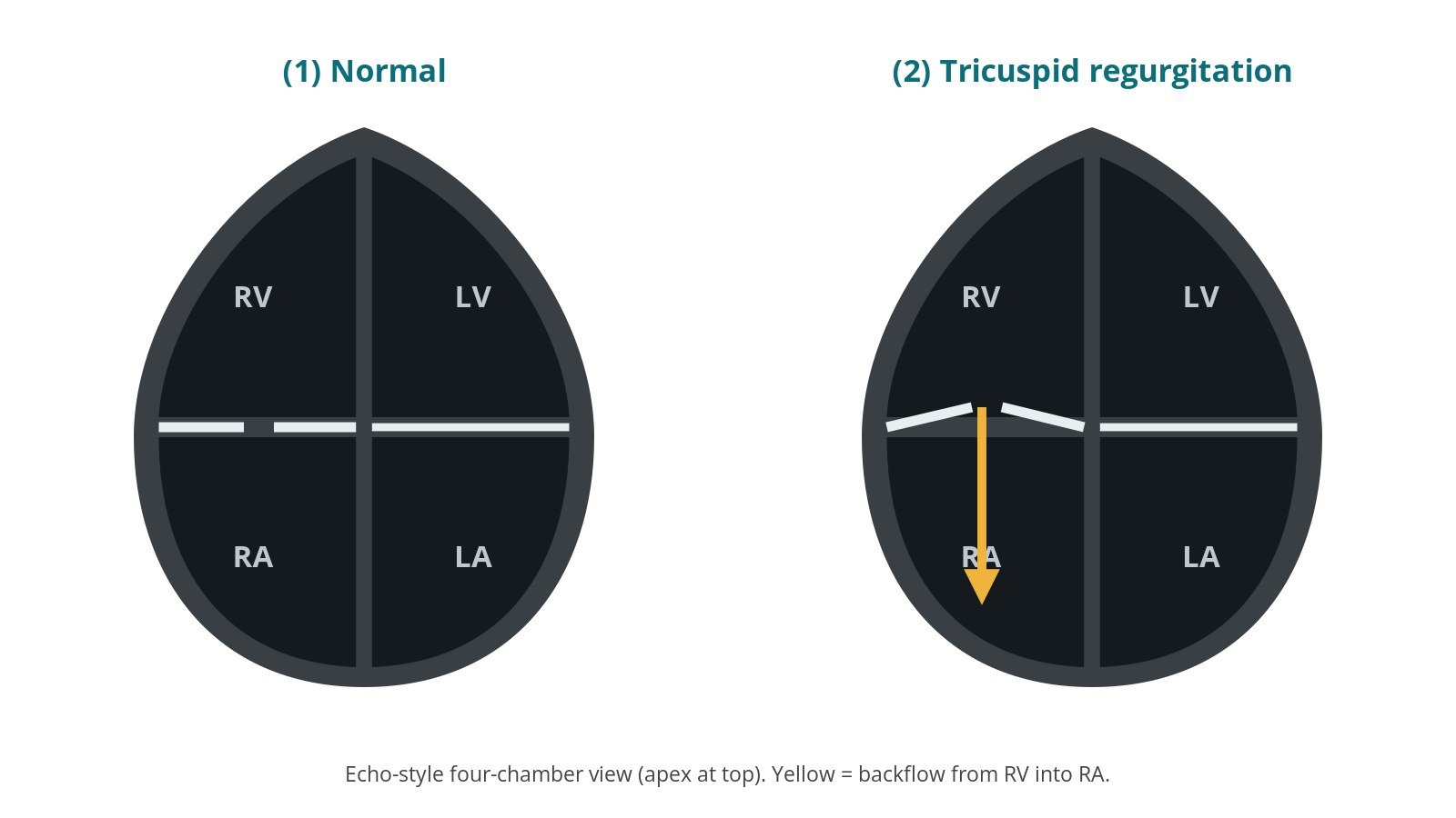 Two echo-style four-chamber heart diagrams: a normal tricuspid valve closed, and tricuspid regurgitation with blood leaking back from the right ventricle into the right atrium