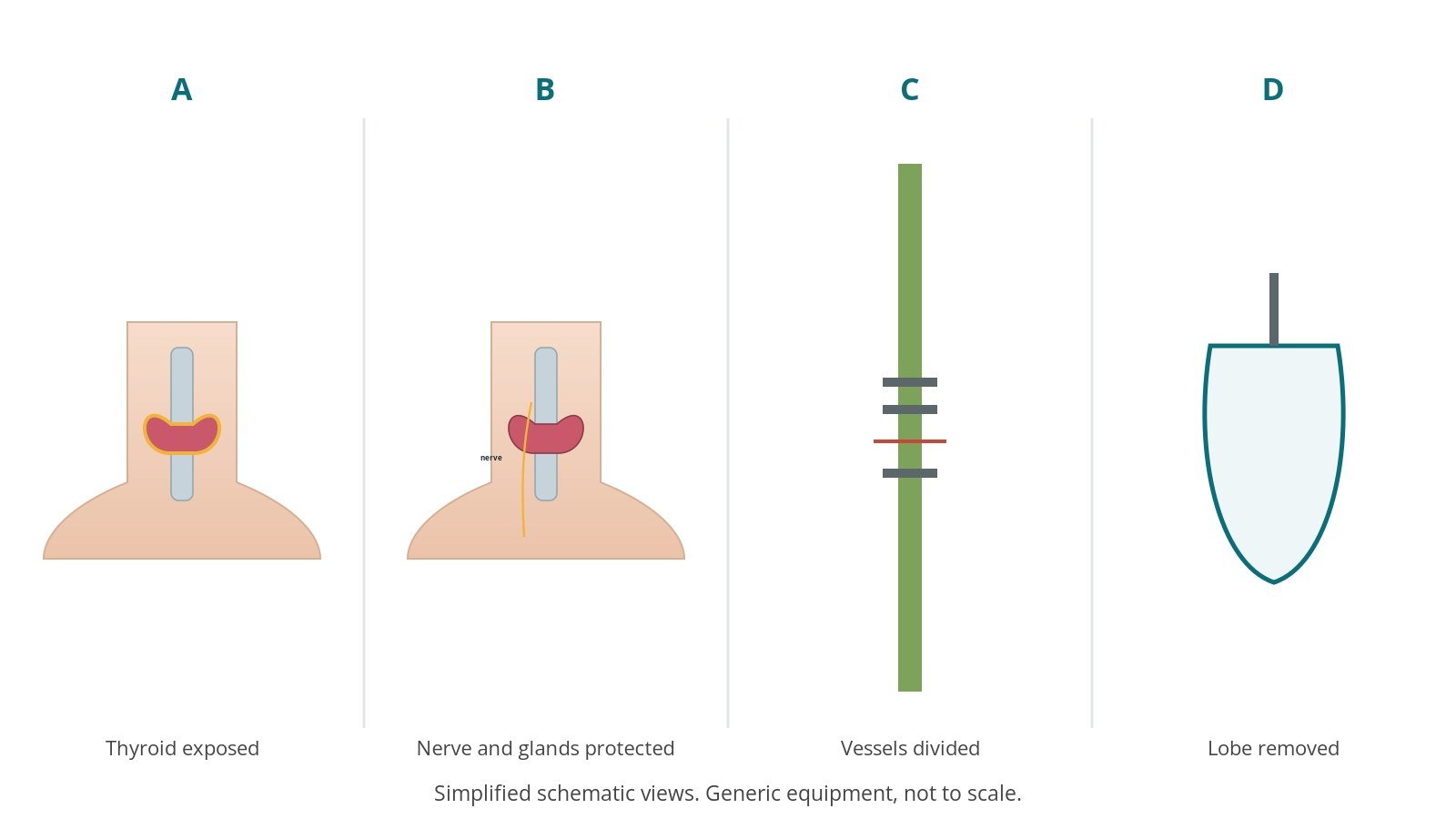 Four-panel schematic of thyroidectomy: thyroid exposed, nerve and glands protected, vessels divided, lobe removed