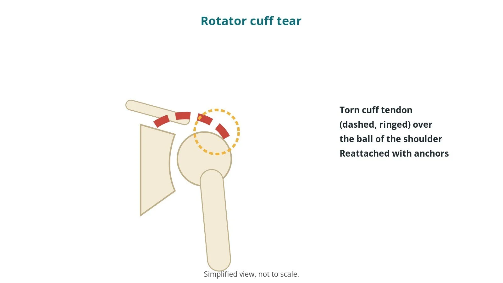 Diagram of the shoulder joint showing a torn tendon over the ball of the arm bone, ringed