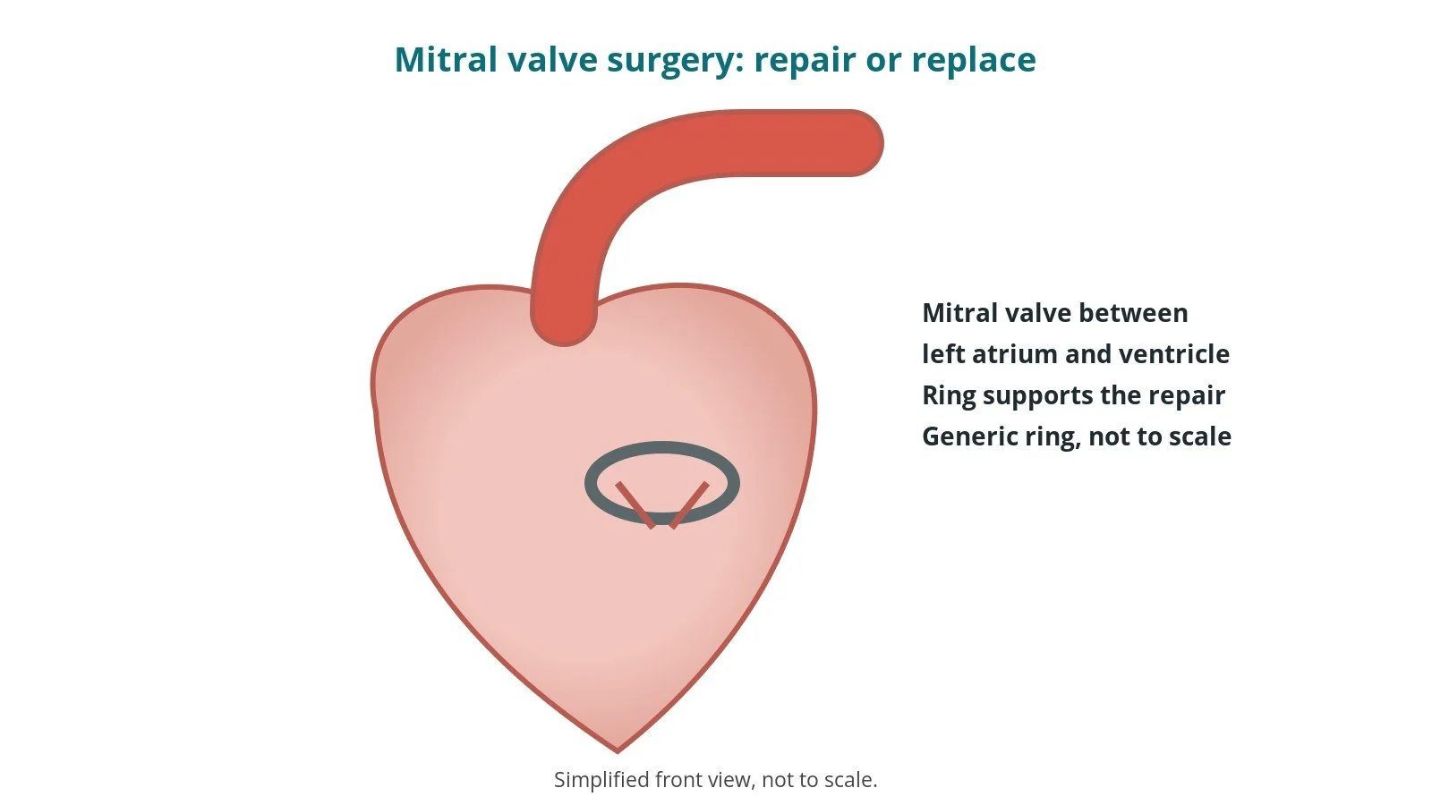 Diagram of the heart showing a supporting ring around the mitral valve between the left atrium and left ventricle