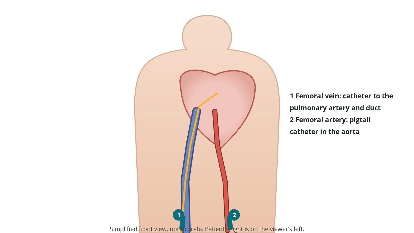 Front view of a patient with sheaths in the right femoral vein and right femoral artery and catheters passing up to the heart and aorta