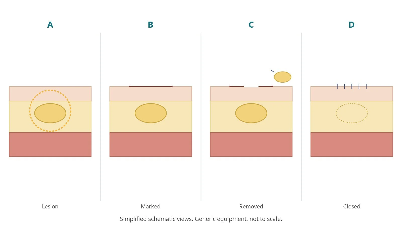 Four-panel schematic of skin lesion excision: lesion, marked, removed, closed
