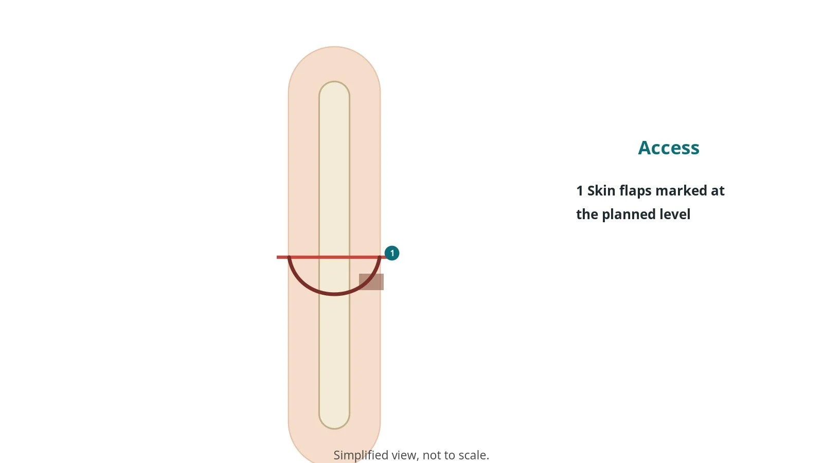 Diagram of a leg with the planned amputation level and skin flap marked below the knee