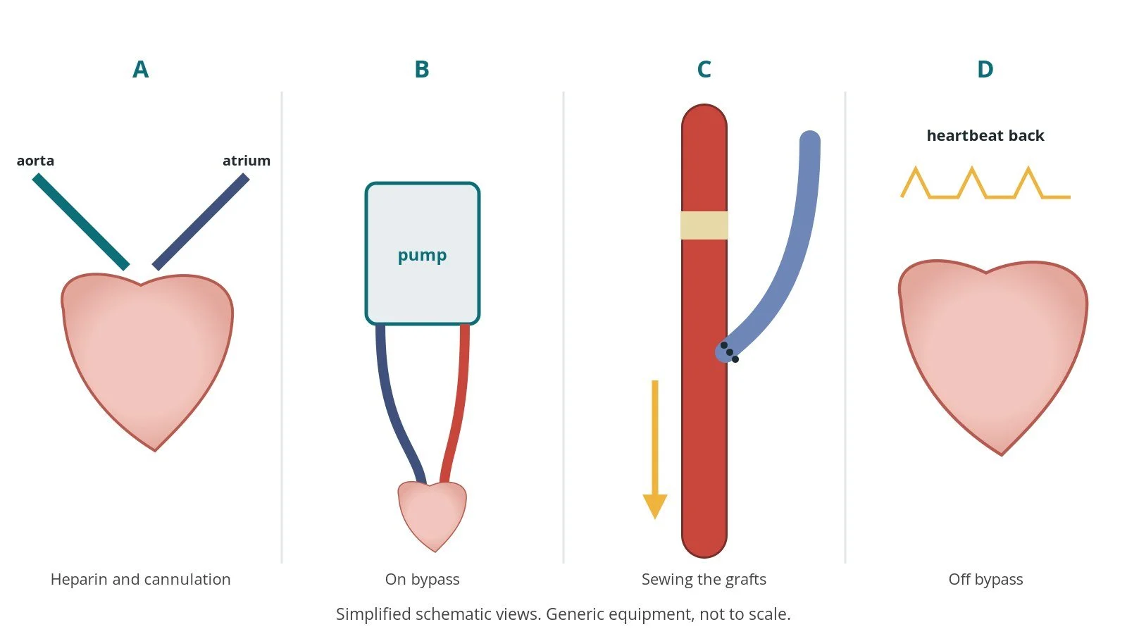 Four-panel schematic of CABG: heparin and cannulation, on bypass, sewing the grafts, off bypass