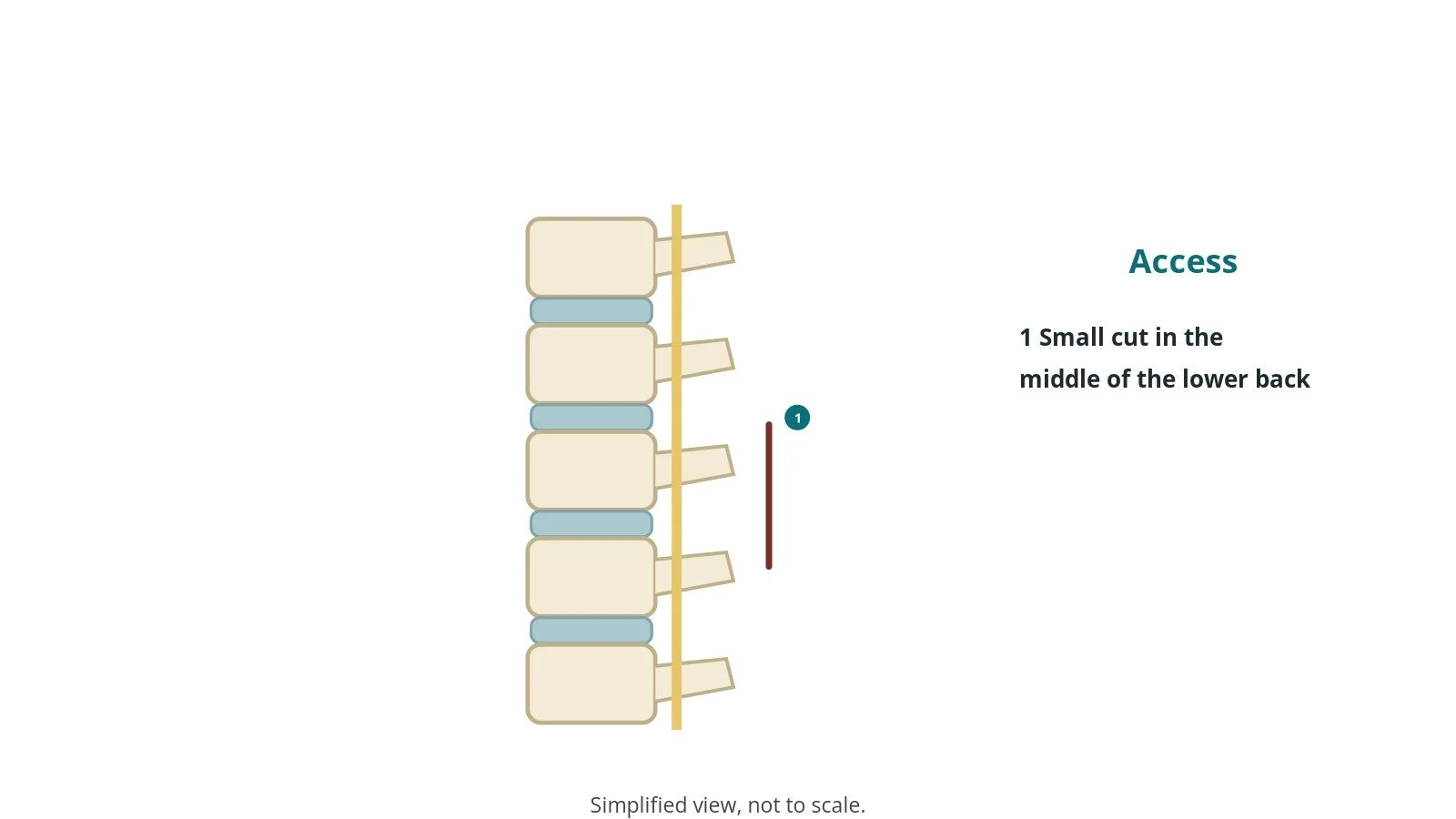 Side diagram of the lower spine showing a short incision over one level at the back