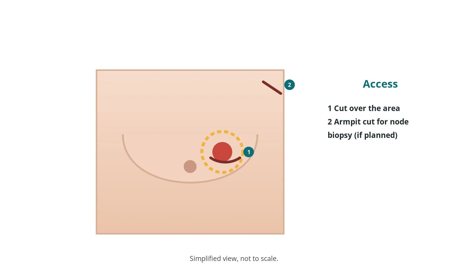 Front view of the chest showing a curved incision on the breast and a small incision in the armpit