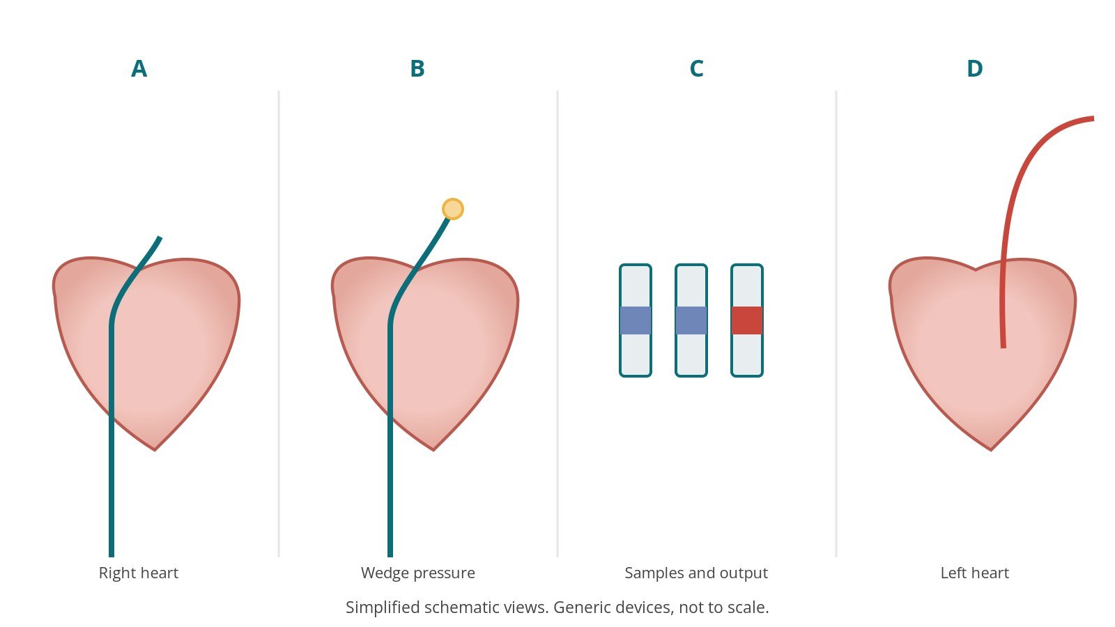Four-panel schematic of right and left heart catheterisation: right heart, wedge pressure, samples and output, left heart