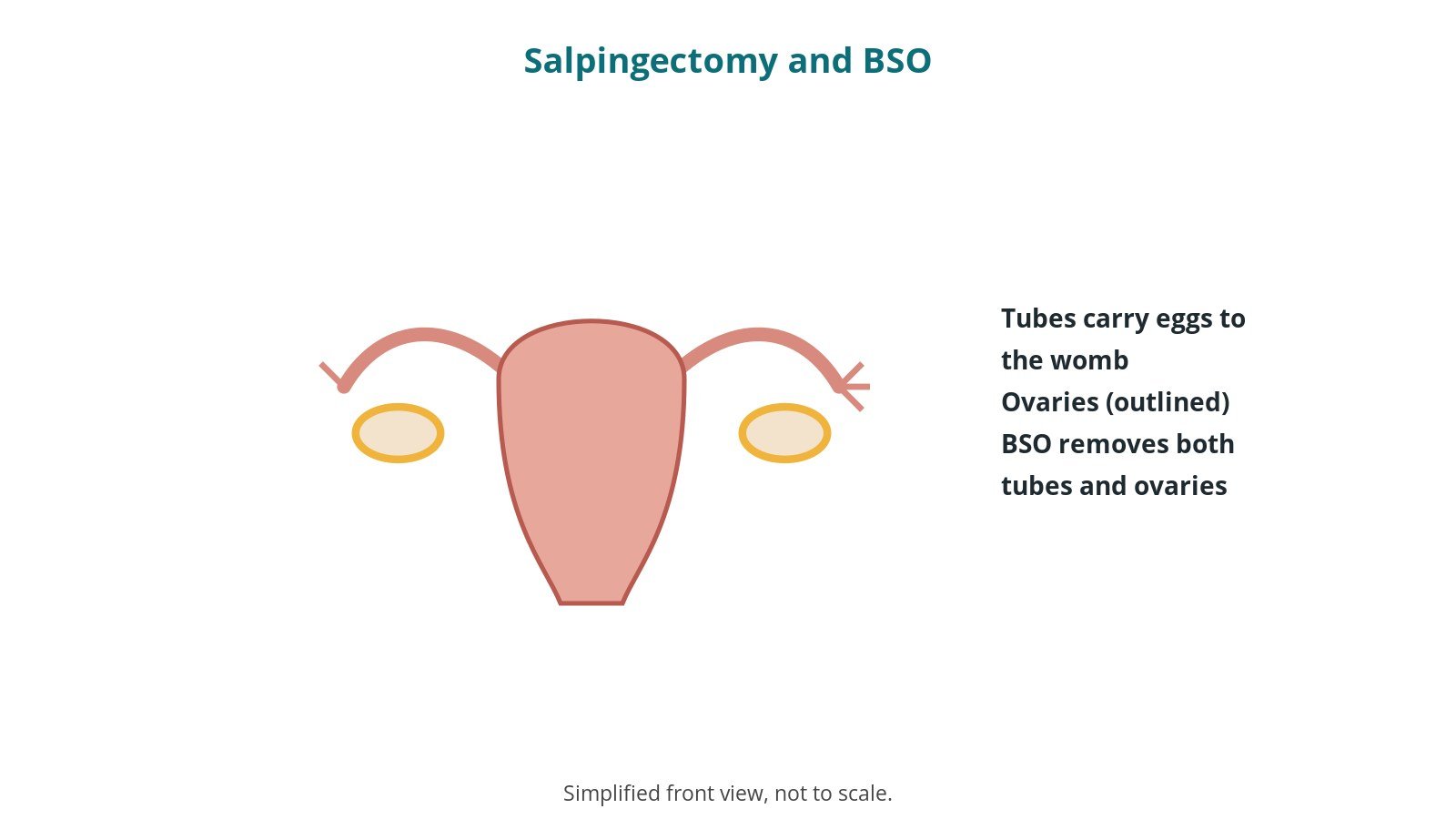 Diagram of the womb with both fallopian tubes and both ovaries, with the ovaries outlined