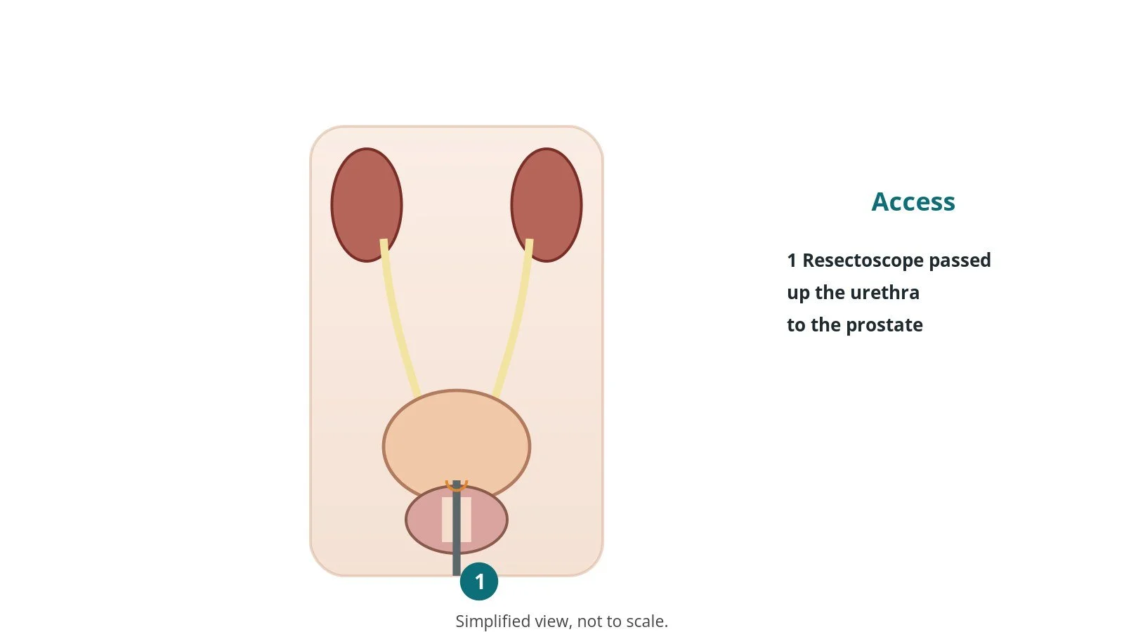 Diagram of the bladder and enlarged prostate with a resectoscope passed up the urethra