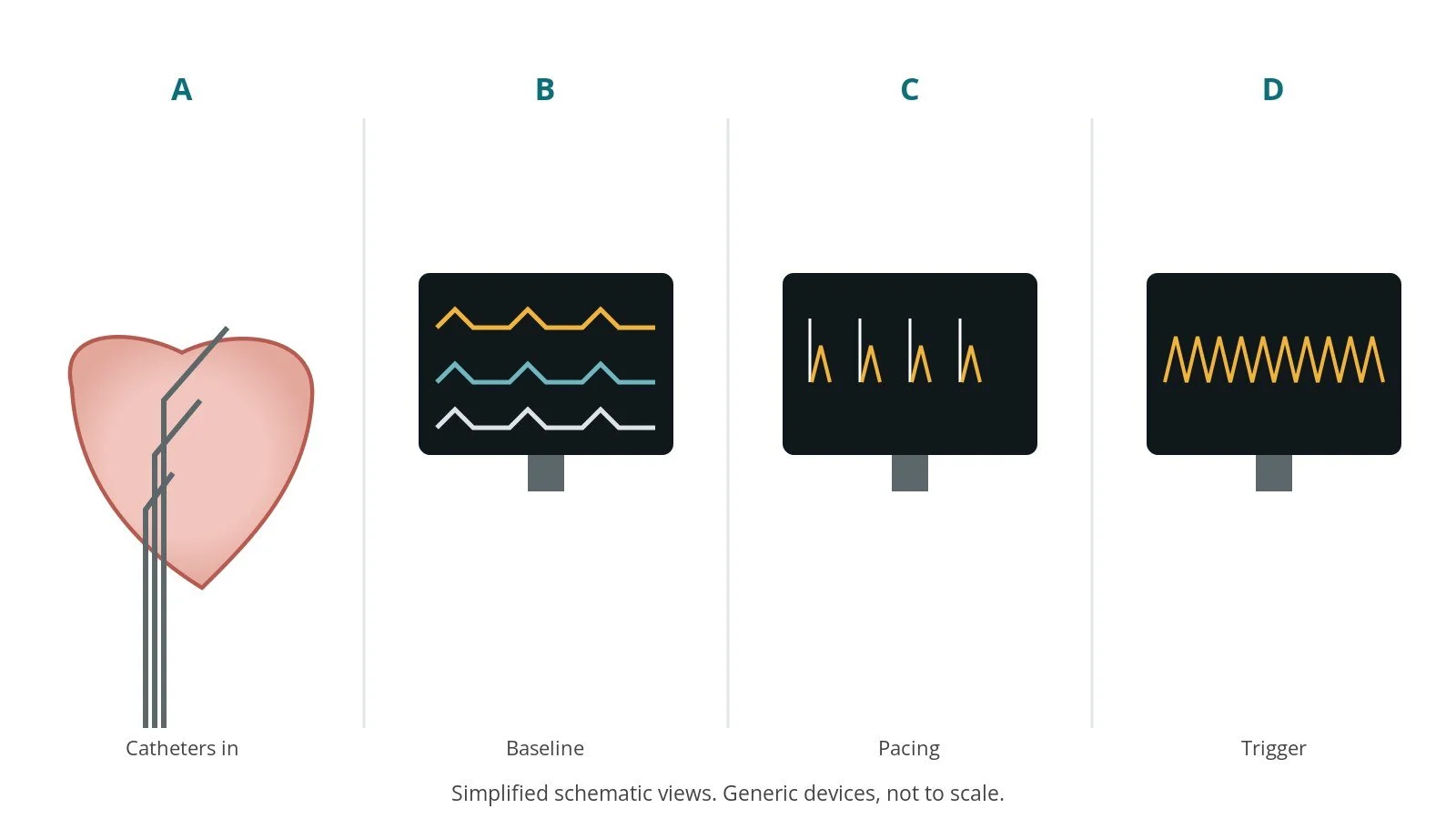 Four-panel schematic of an EP study: catheters in, baseline, pacing, trigger