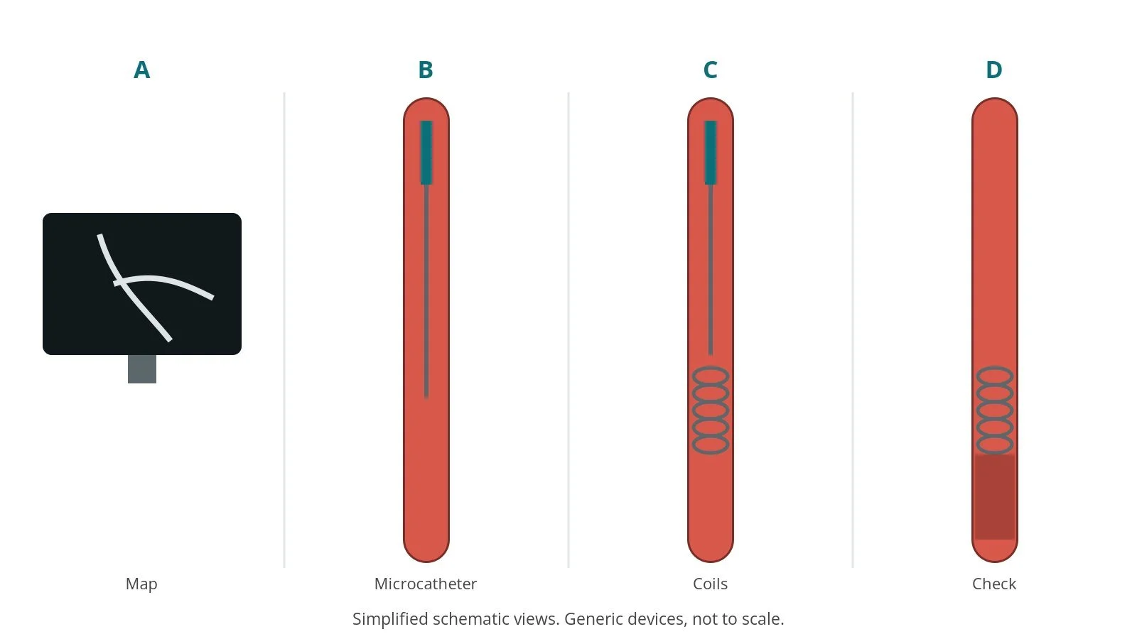 Four-panel schematic of coil embolisation: map, microcatheter, coils, check