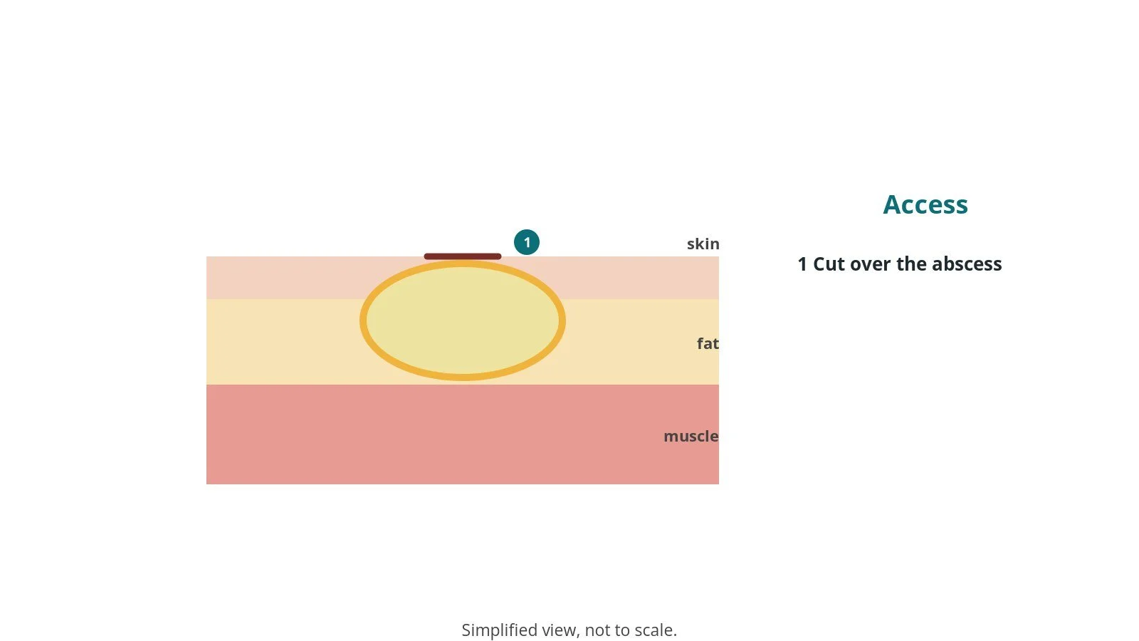 Cross-section of skin, fat and muscle showing a cut made over an abscess collection