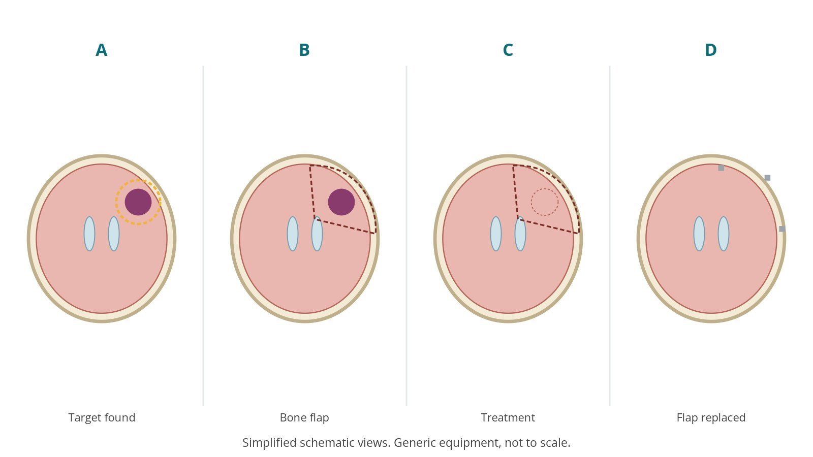 Four-panel schematic of craniotomy: target found, bone flap, treatment, flap replaced