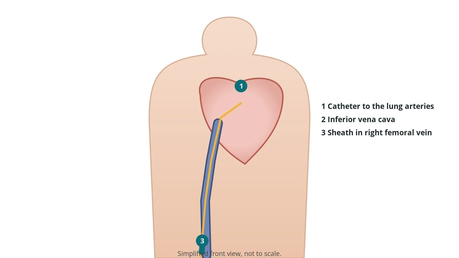 Front view of a patient showing a catheter from the right femoral vein in the groin up the inferior vena cava to the right side of the heart