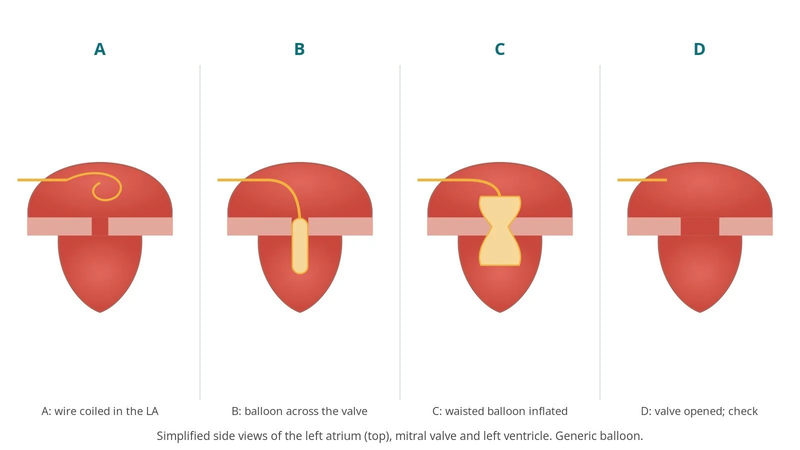 Four-panel diagram of balloon mitral valvuloplasty: a wire coiled in the left atrium, the balloon crossing the mitral valve, the waisted balloon inflated in the valve, and the valve opened