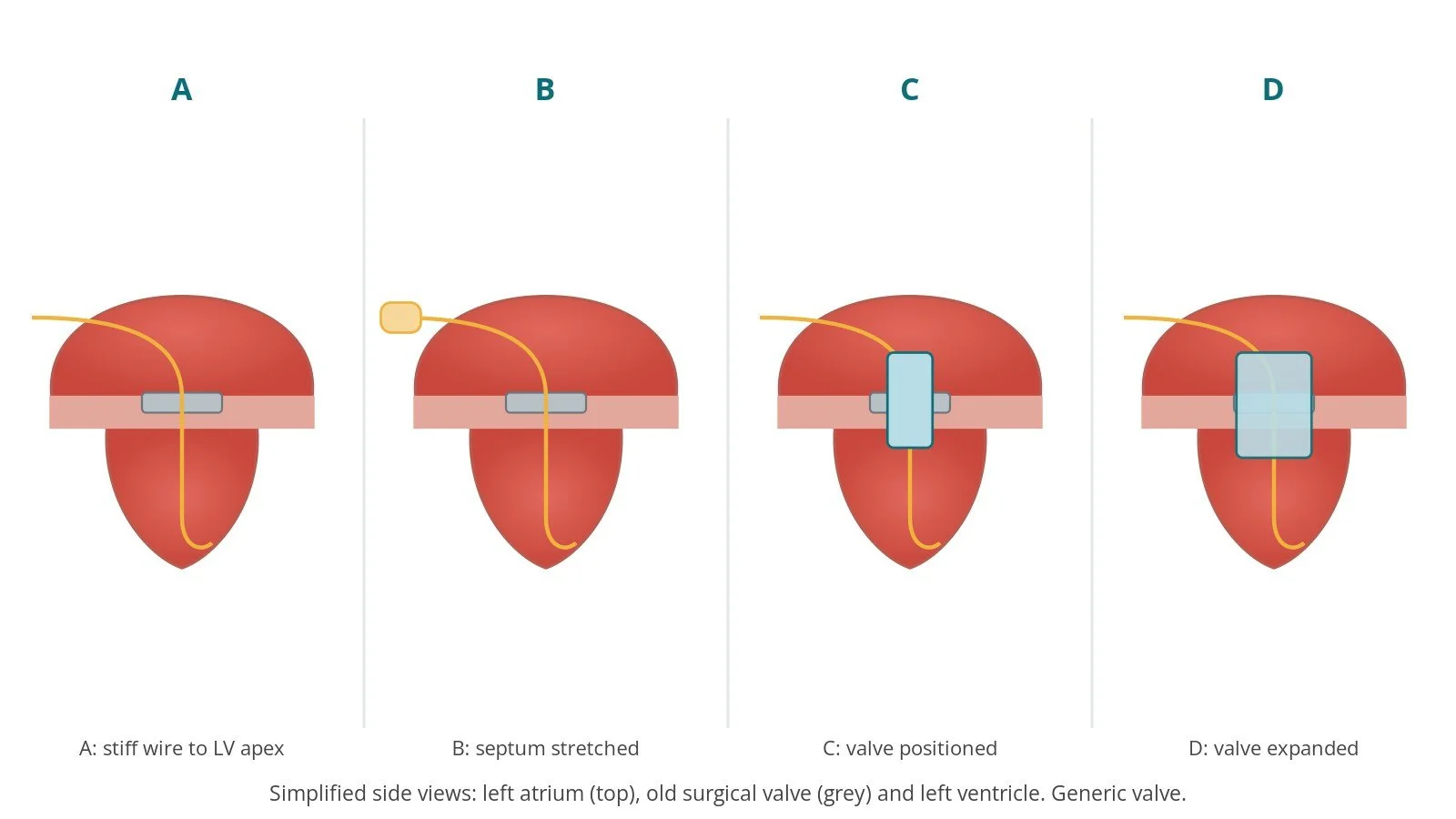 Four-panel diagram of TMVI: wire across the old valve to the left ventricular apex, balloon stretching the septum, valve positioned in the old valve, and valve expanded