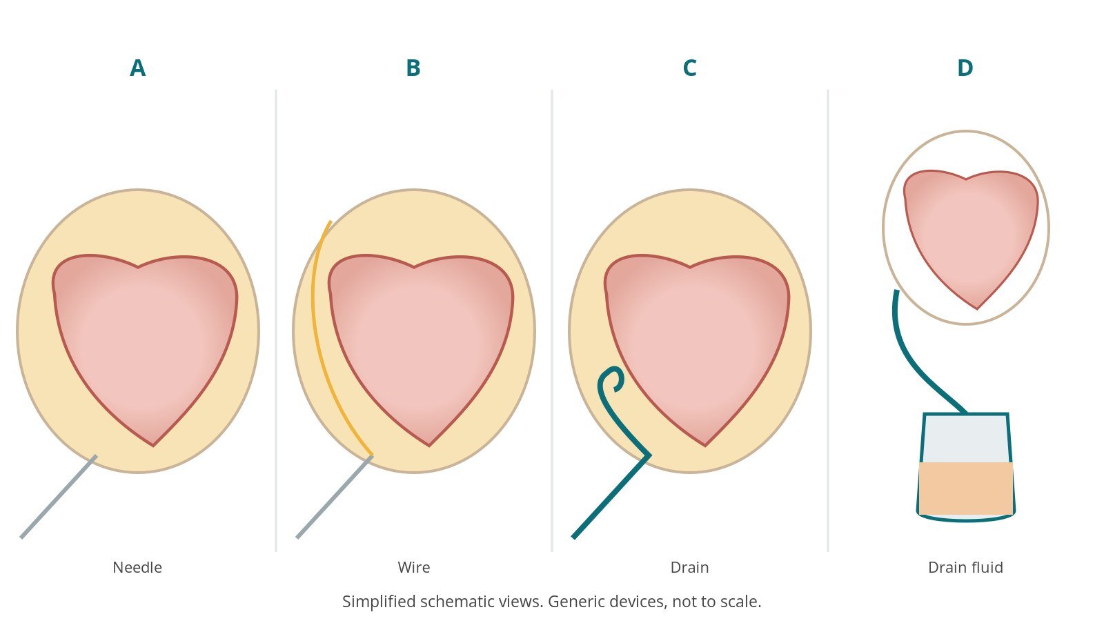 Four-panel schematic of pericardiocentesis: needle, wire, drain, drain fluid