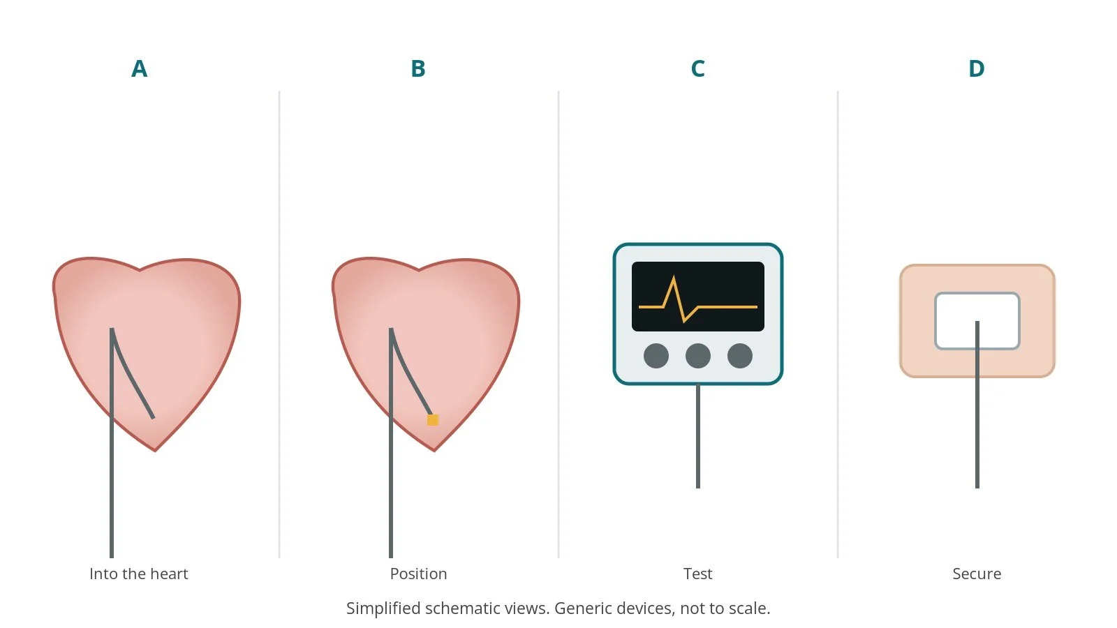 Four-panel schematic of temporary pacing wire insertion: into the heart, position, test, secure