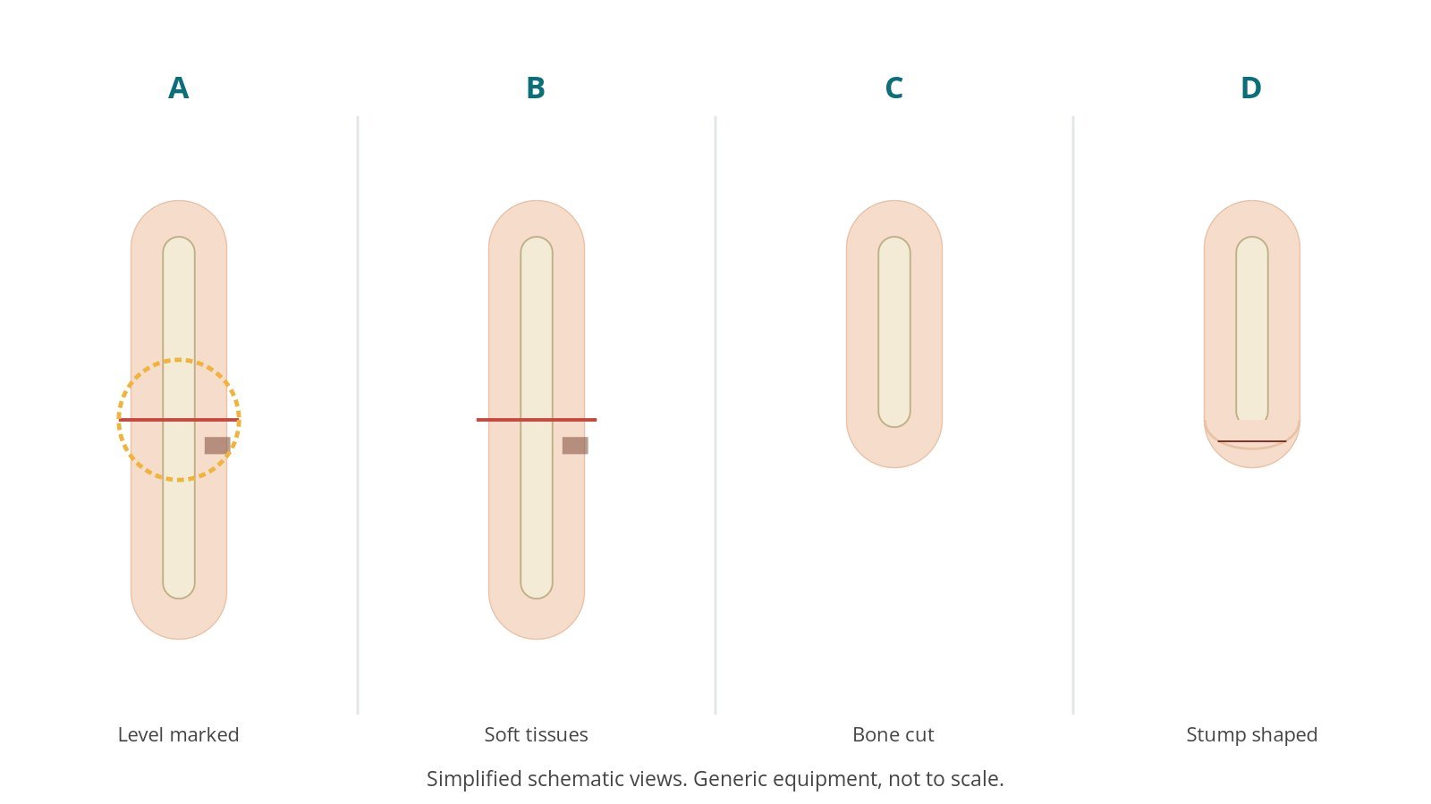 Four-panel schematic of major amputation: level marked, soft tissues, bone cut, stump shaped