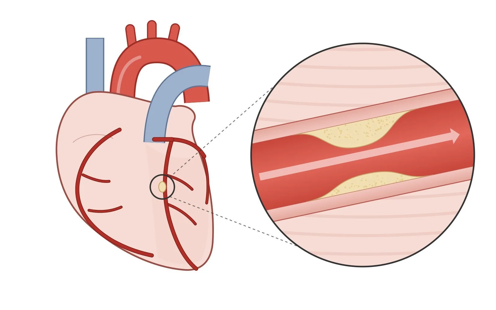 Diagram 1: the coronary arteries with a narrowing