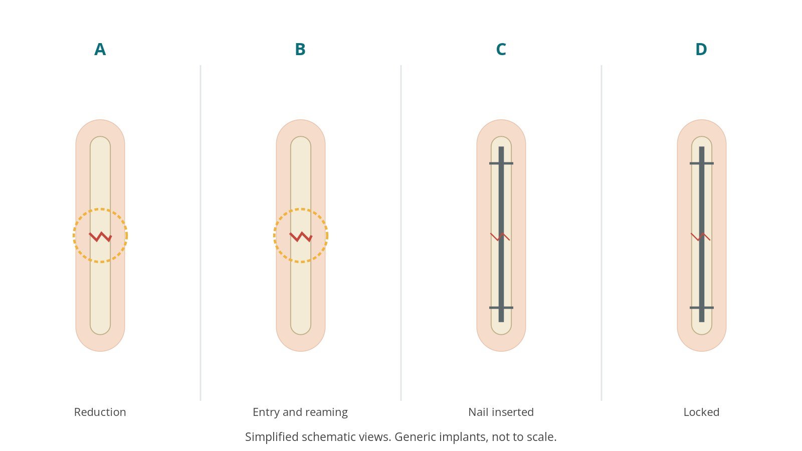Four-panel schematic of femur and tibia fixation: reduction, entry and reaming, nail inserted, locked