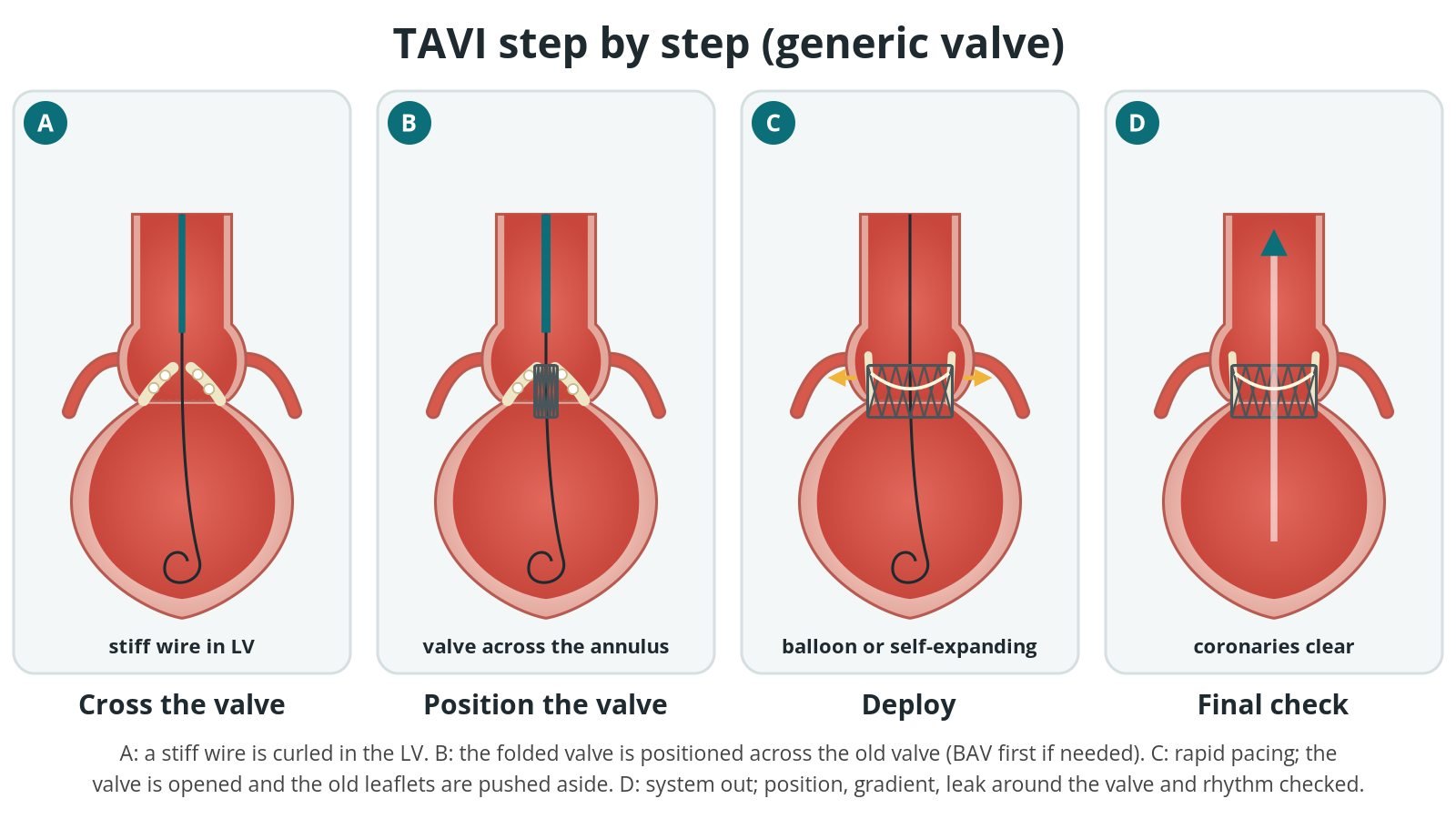 Four-panel diagram of TAVI with a generic valve: a stiff wire across the narrowed valve into the left ventricle, the folded valve positioned across the old valve, the valve opened, and a final check with the coronary arteries clear