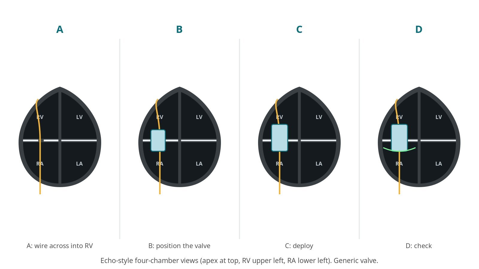 Four-panel diagram of TTVI: a wire across the tricuspid valve into the right ventricle, the valve positioned, the valve expanded and a final check