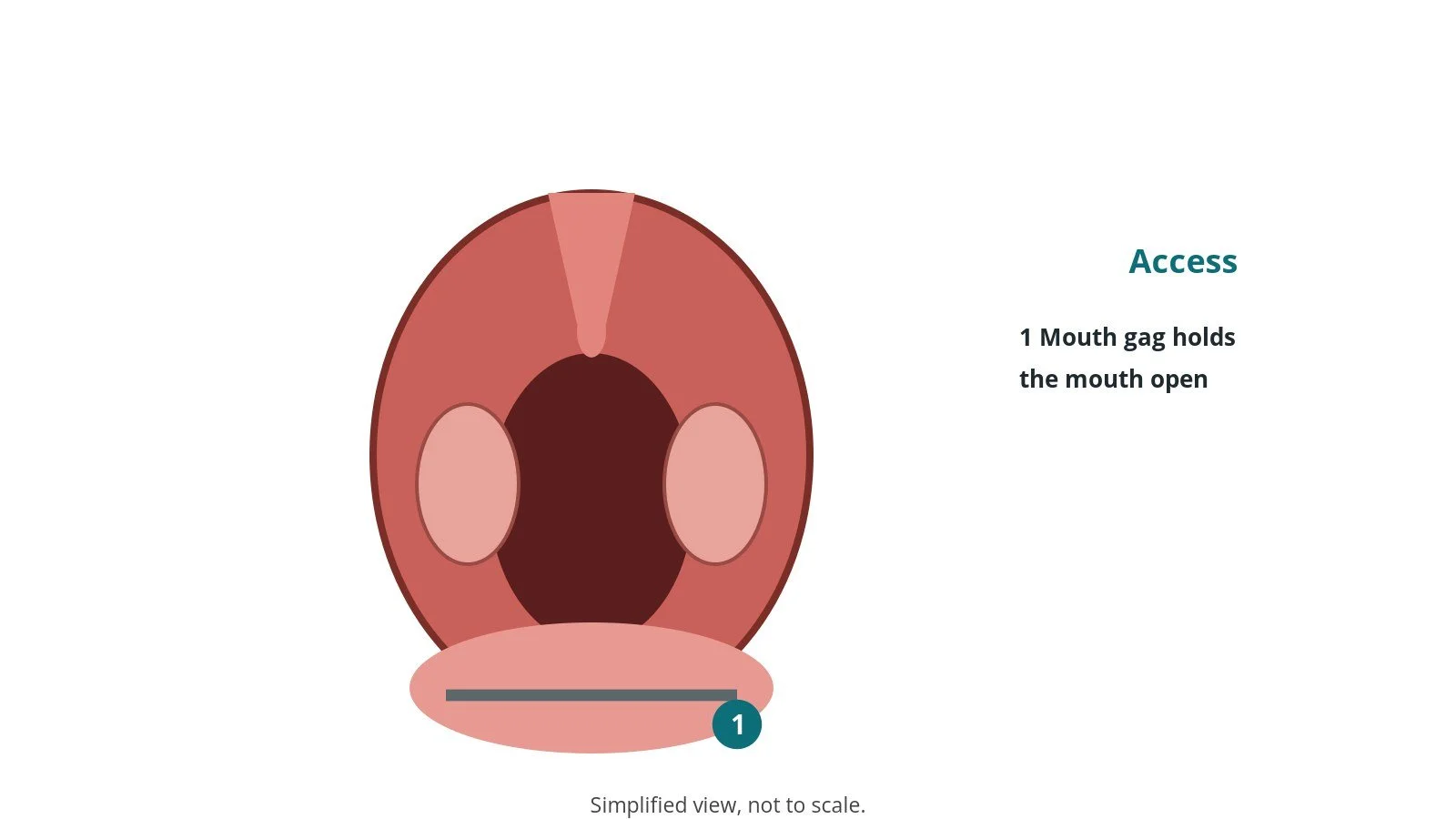 Diagram of an open mouth showing both tonsils and a mouth gag holding the mouth open