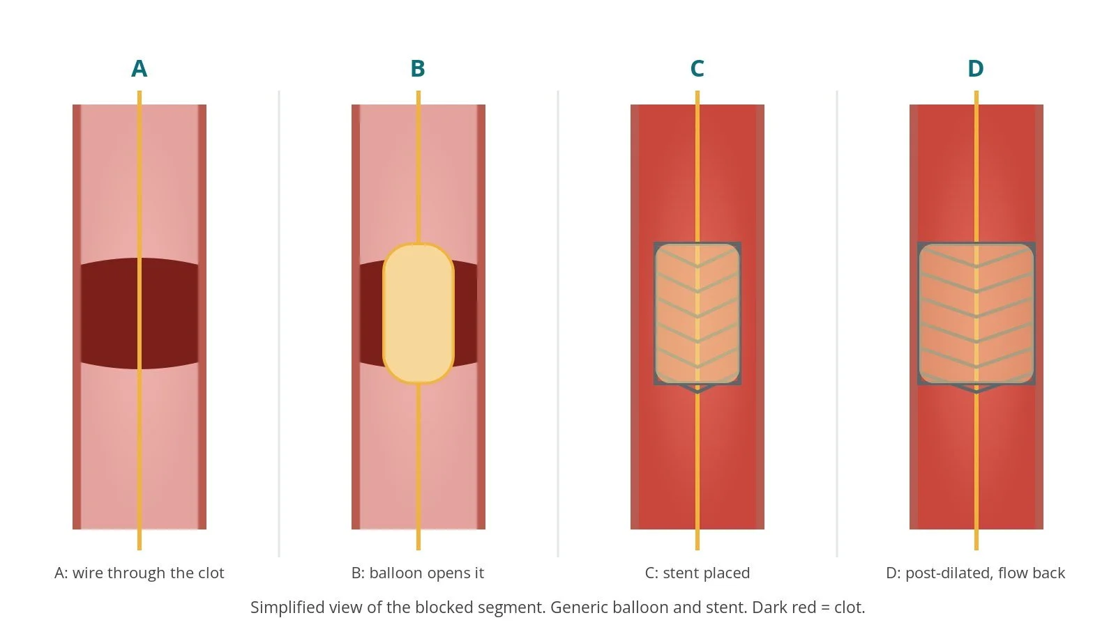 Four-panel diagram of primary PCI: a wire through a clot, a balloon opening the blockage, a stent expanded, and the stent fully opened with flow restored