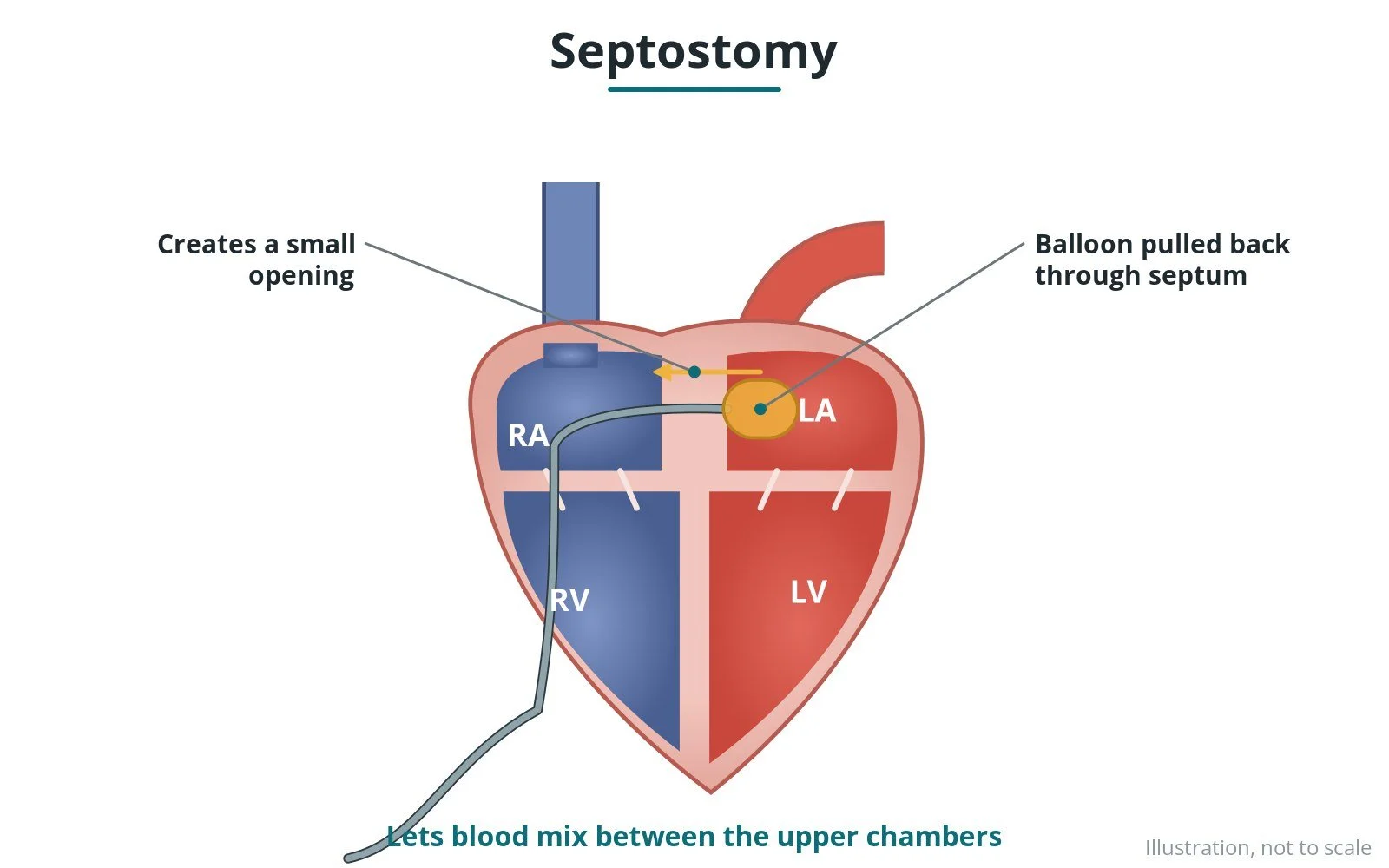 Diagram of a balloon catheter enlarging the opening between the upper chambers of the heart