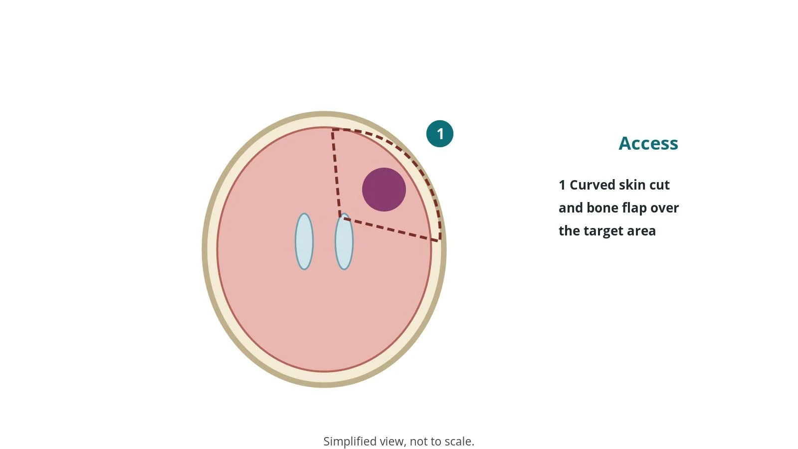Diagram of the head from above with a dashed bone flap outline over a brain tumour